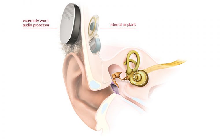 Baha Bahs Hearing Aid And System Bone Anchored Hearing System Dr Lynne Lim Ent And Hearing Centre 5370